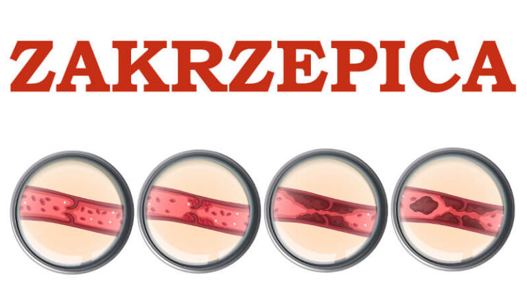Zakrzepica